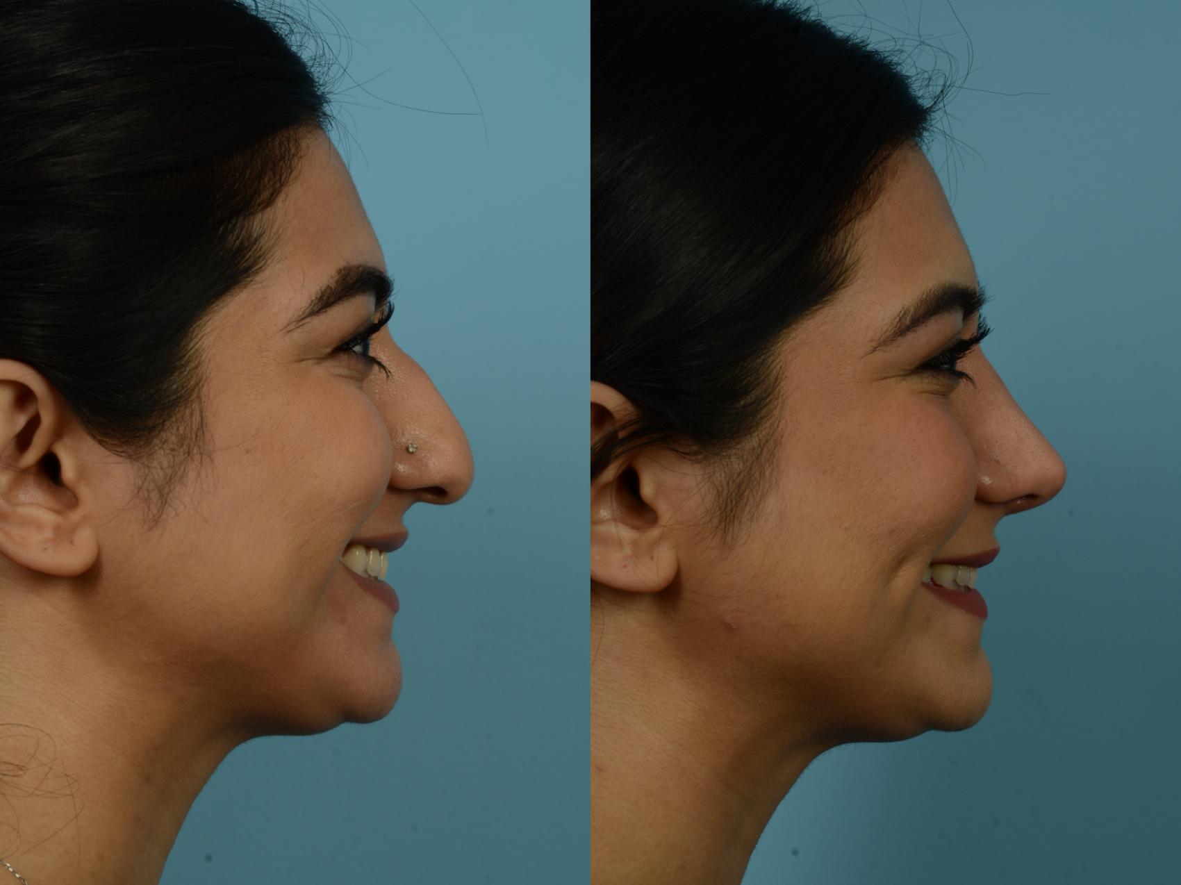 Before & After Rhinoplasty by Dr. Sinno Case 846 Right Side View in Chicago, IL