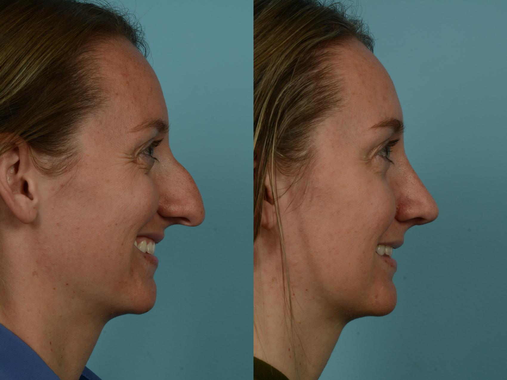 Before & After Rhinoplasty by Dr. Sinno Case 847 Right Side View in Chicago, IL