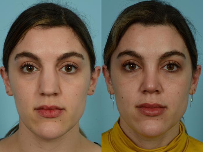Before & After Rhinoplasty by Dr. Sinno Case 851 Front View in Chicago, IL