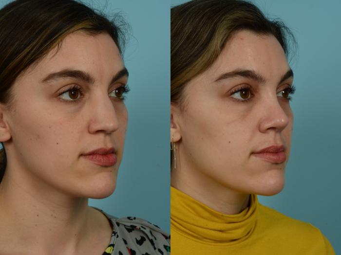 Before & After Rhinoplasty by Dr. Sinno Case 851 Left Oblique View in Chicago, IL