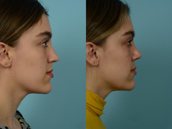 Before & After Rhinoplasty by Dr. Sinno Case 851 Left Side View in Chicago, IL