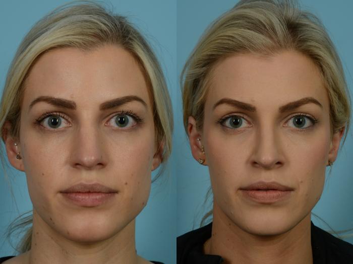 Before & After Rhinoplasty by Dr. Sinno Case 853 Front View in Chicago, IL