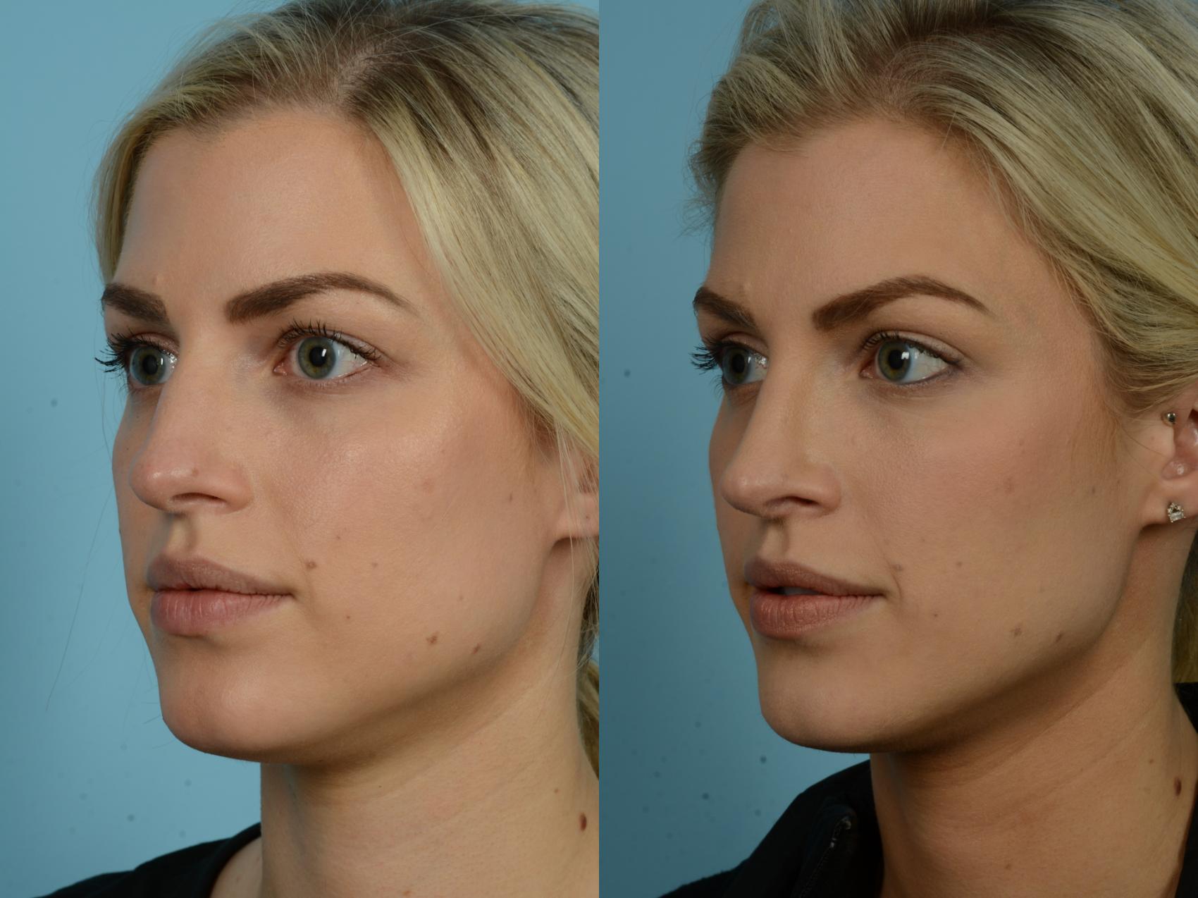 Before & After Rhinoplasty by Dr. Sinno Case 853 Left Oblique View in Chicago, IL
