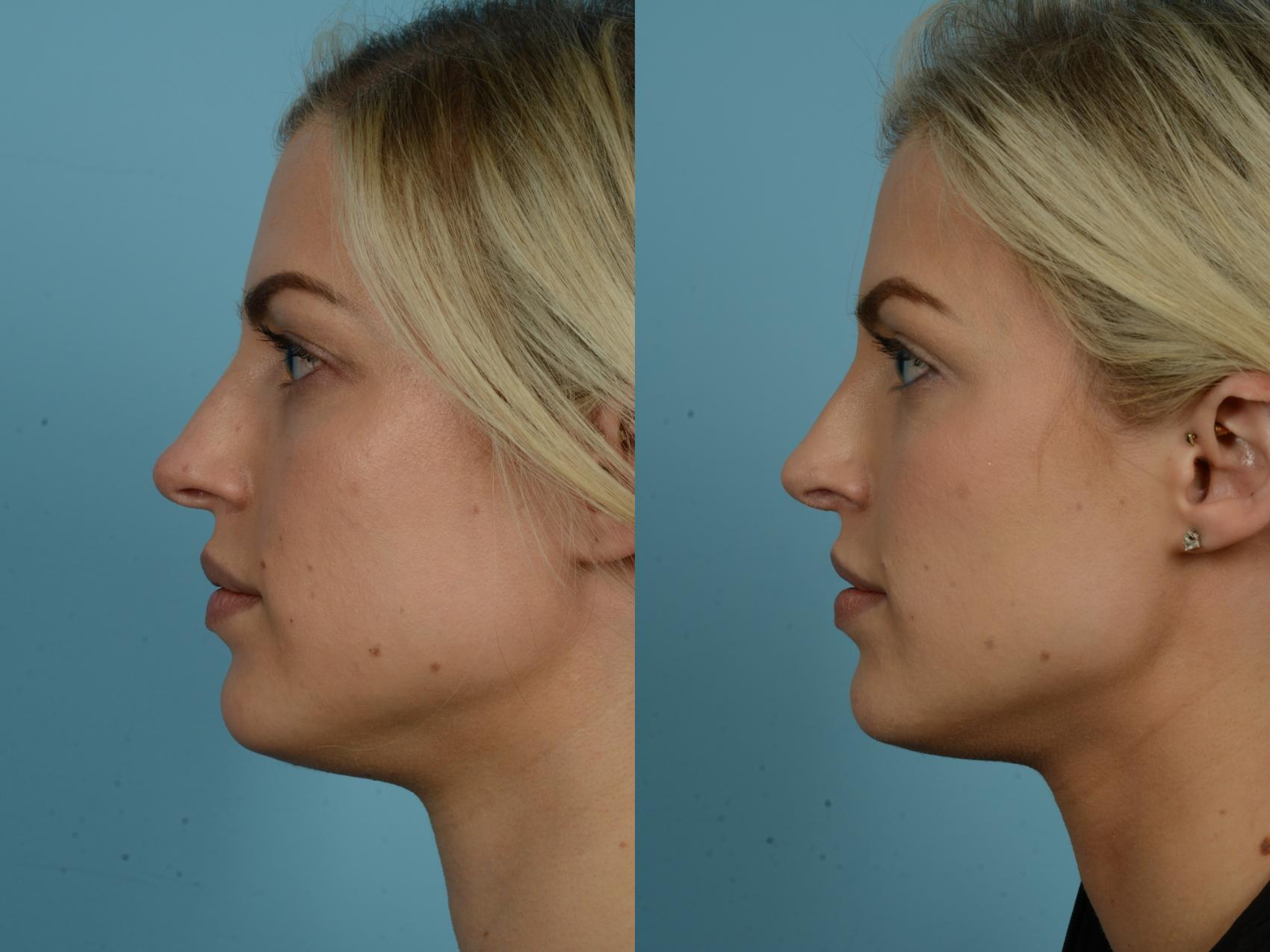 Rhinoplasty By Dr Sinno Before And After Pictures Case 853 Chicago Il Tlkm Plastic Surgery 