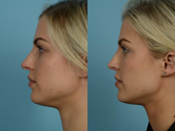 Before & After Rhinoplasty by Dr. Sinno Case 853 Left Side View in Chicago, IL