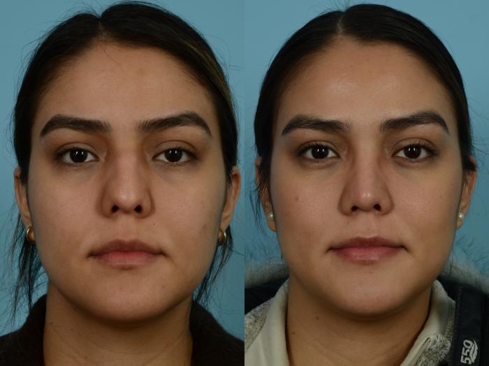 Before & After Rhinoplasty by Dr. Sinno Case 854 Front View in Chicago, IL
