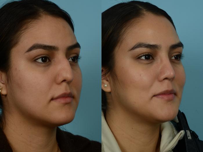 Before & After Rhinoplasty by Dr. Sinno Case 854 Right Oblique View in Chicago, IL