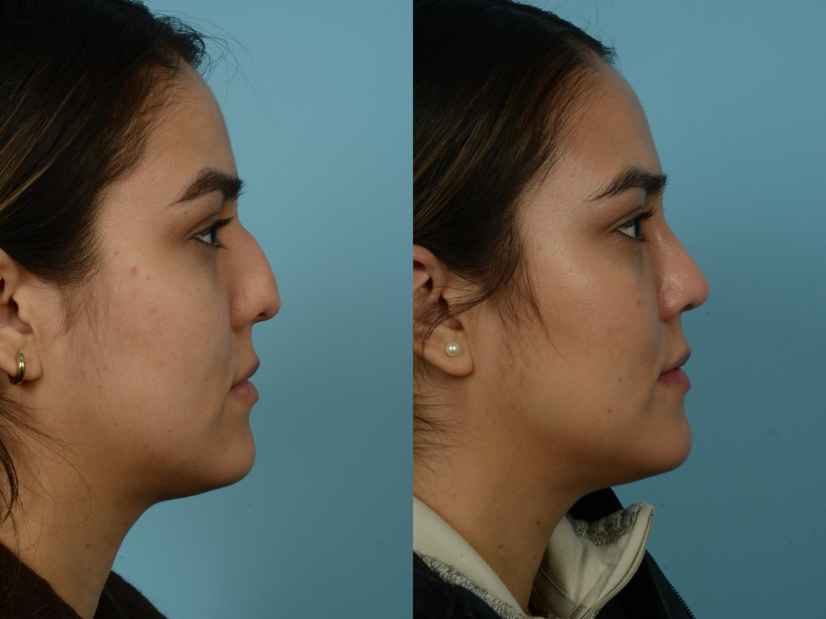 Before & After Rhinoplasty by Dr. Sinno Case 854 Right Side View in Chicago, IL