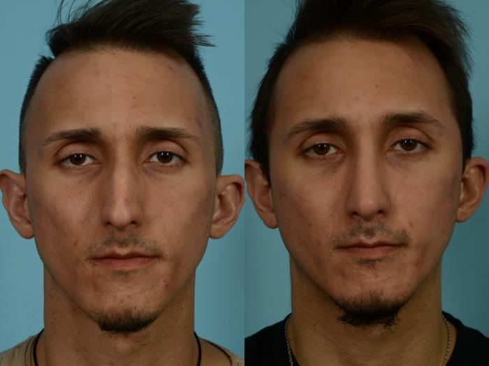 Before & After Rhinoplasty by Dr. Sinno Case 855 Front View in Chicago, IL
