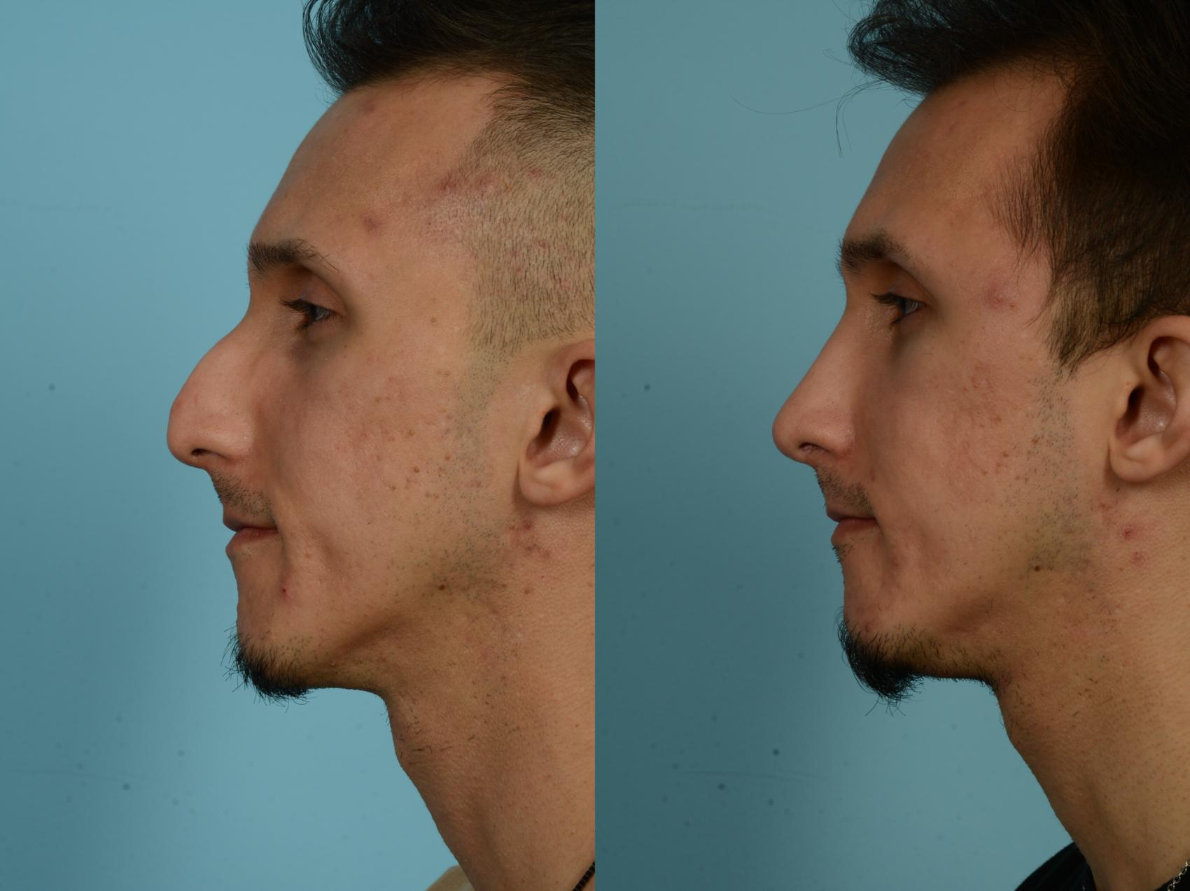 Before & After Rhinoplasty by Dr. Sinno Case 855 Left Side View in Chicago, IL