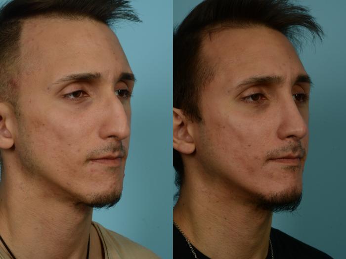 Before & After Rhinoplasty by Dr. Sinno Case 855 Right Oblique View in Chicago, IL