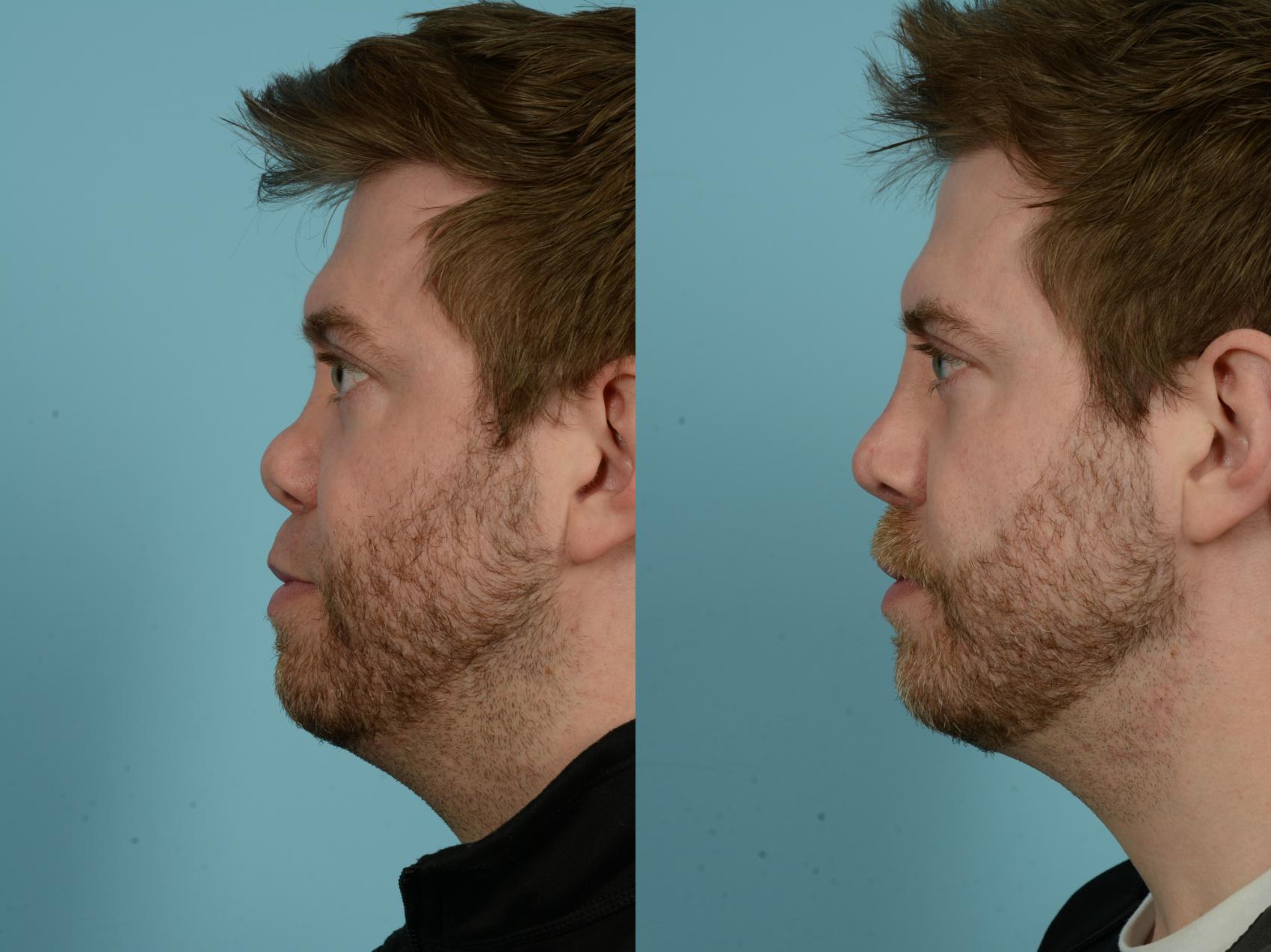 Before & After Rhinoplasty by Dr. Sinno Case 856 Left Side View in Chicago, IL