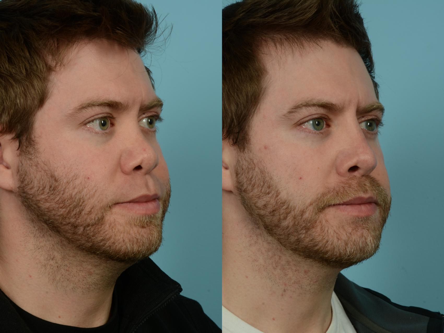 Before & After Rhinoplasty by Dr. Sinno Case 856 Right Oblique View in Chicago, IL