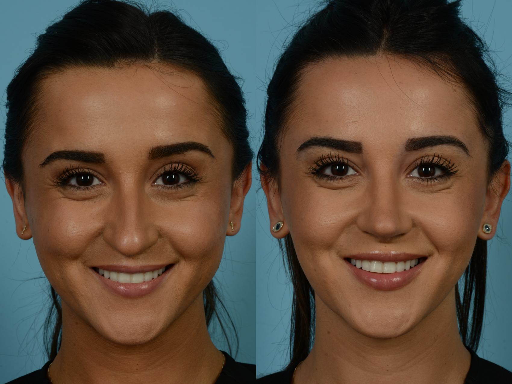 Before & After Rhinoplasty by Dr. Sinno Case 857 Front View in Chicago, IL