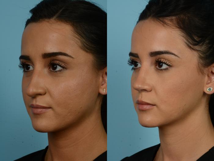 Before & After Rhinoplasty by Dr. Sinno Case 857 Left Oblique View in Chicago, IL