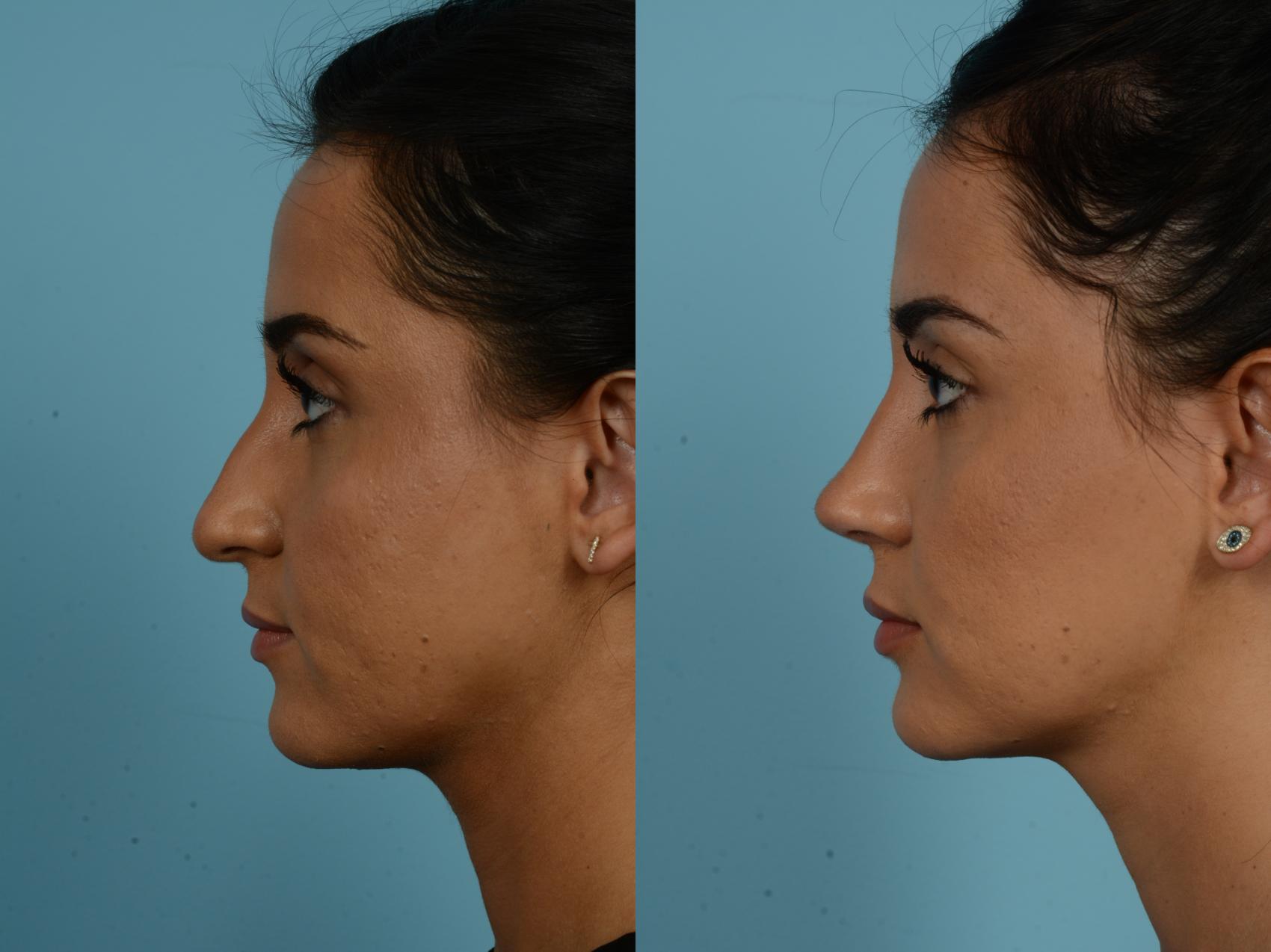 Before & After Rhinoplasty by Dr. Sinno Case 857 Left Side View in Chicago, IL