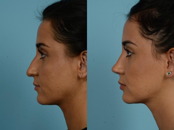 Before & After Rhinoplasty by Dr. Sinno Case 857 Left Side View in Chicago, IL