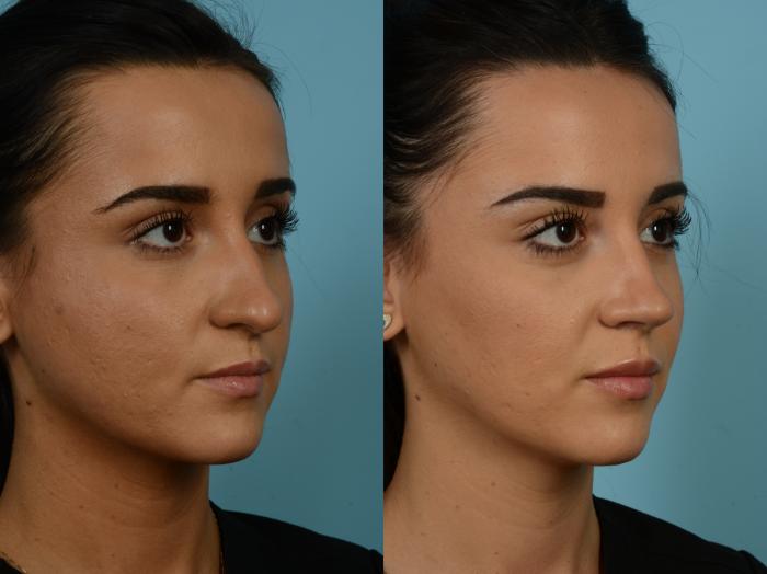 Before & After Rhinoplasty by Dr. Sinno Case 857 Right Oblique View in Chicago, IL