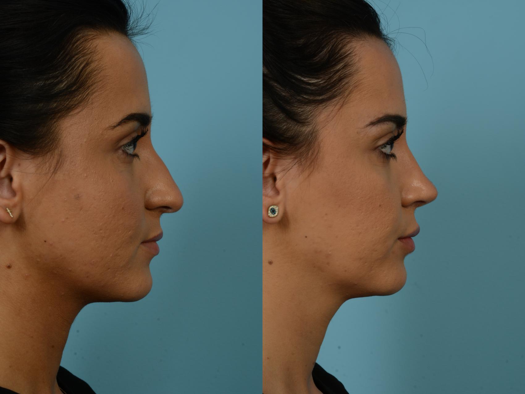 Before & After Rhinoplasty by Dr. Sinno Case 857 Right Side View in Chicago, IL