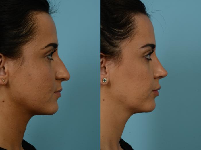 Before & After Rhinoplasty by Dr. Sinno Case 857 Right Side View in Chicago, IL