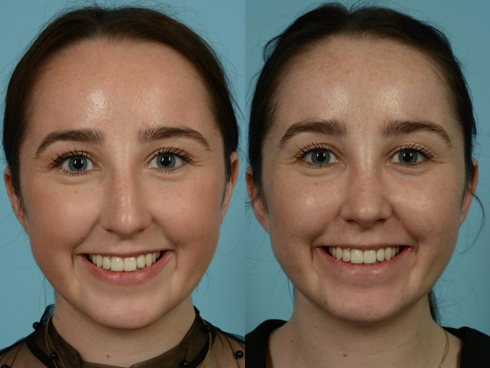 Before & After Rhinoplasty by Dr. Sinno Case 859 Front View in Chicago, IL