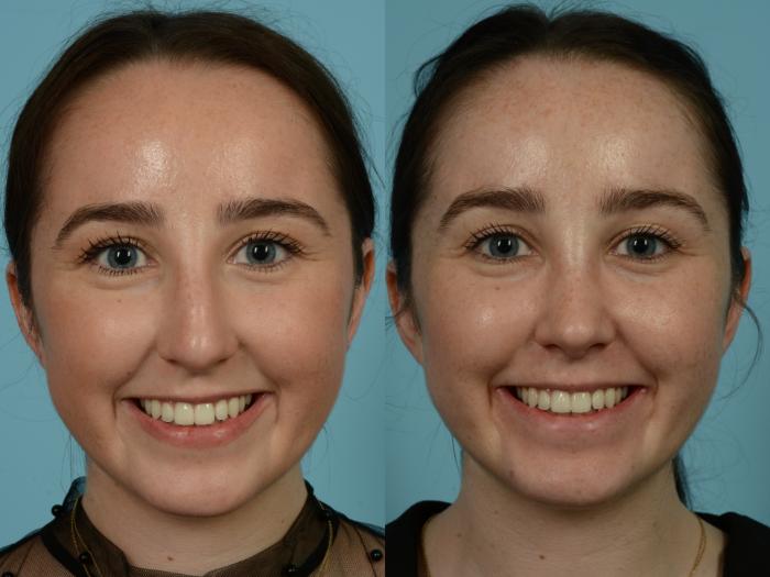 Before & After Rhinoplasty by Dr. Sinno Case 859 Front View in Chicago, IL