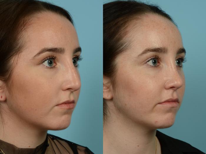 Before & After Rhinoplasty by Dr. Sinno Case 859 Right Oblique View in Chicago, IL