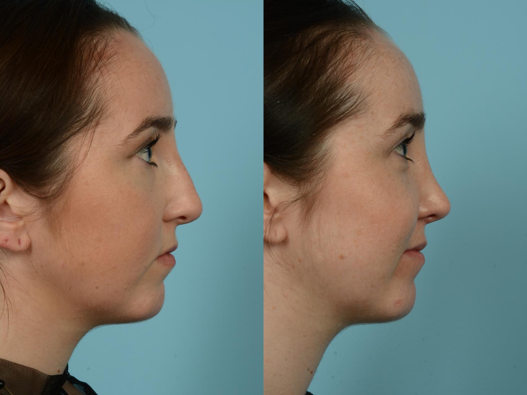 Before & After Rhinoplasty by Dr. Sinno Case 859 Right Side View in Chicago, IL