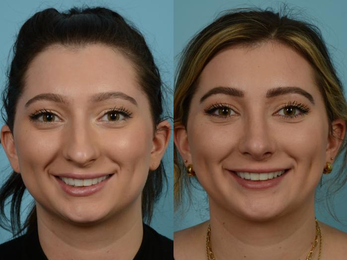 Before & After Rhinoplasty by Dr. Sinno Case 861 Front View in Chicago, IL