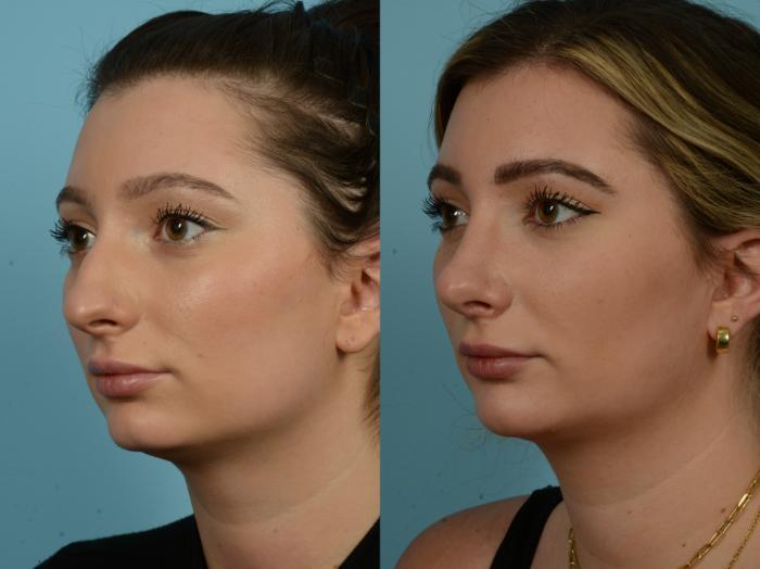 Before & After Rhinoplasty by Dr. Sinno Case 861 Left Oblique View in Chicago, IL