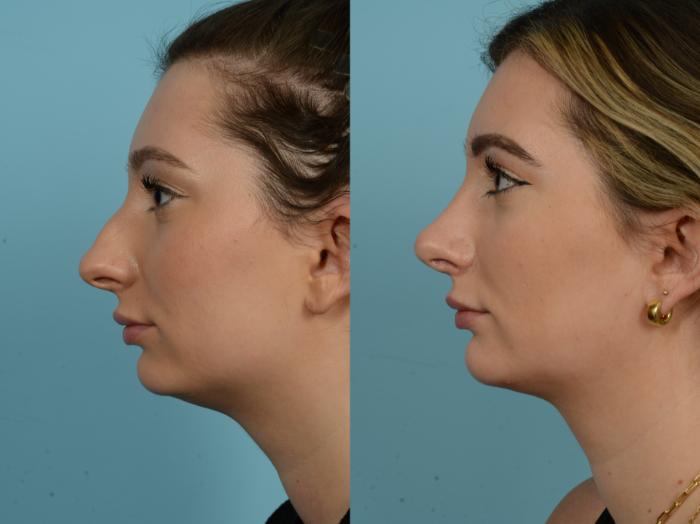 Before & After Rhinoplasty by Dr. Sinno Case 861 Left Side View in Chicago, IL
