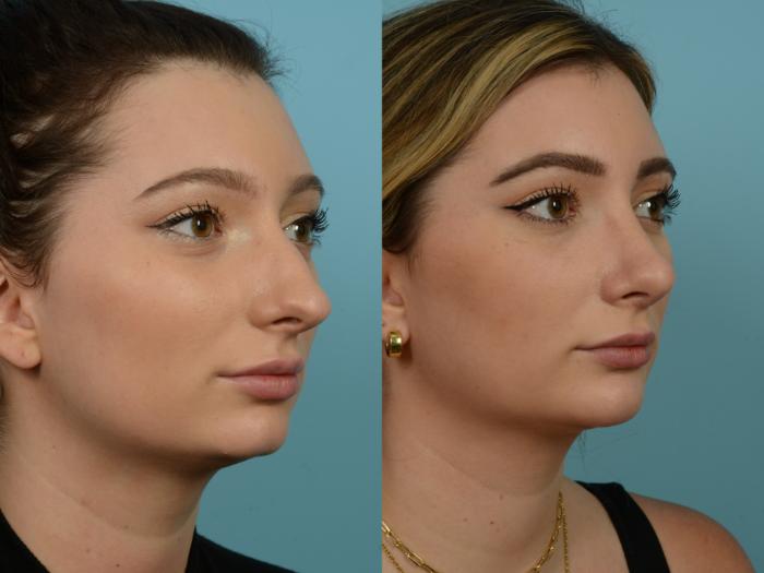 Before & After Rhinoplasty by Dr. Sinno Case 861 Right Oblique View in Chicago, IL