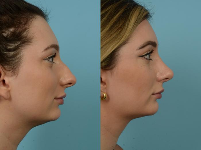 Before & After Rhinoplasty by Dr. Sinno Case 861 Right Side View in Chicago, IL
