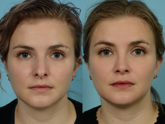 Before & After Rhinoplasty by Dr. Sinno Case 862 Front View in Chicago, IL