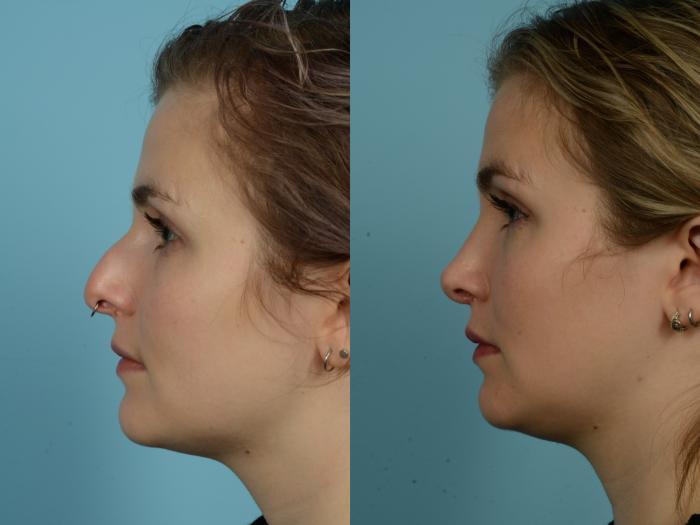 Before & After Rhinoplasty by Dr. Sinno Case 862 Left Side View in Chicago, IL