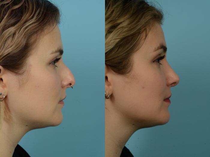Before & After Rhinoplasty by Dr. Sinno Case 862 Right Side View in Chicago, IL