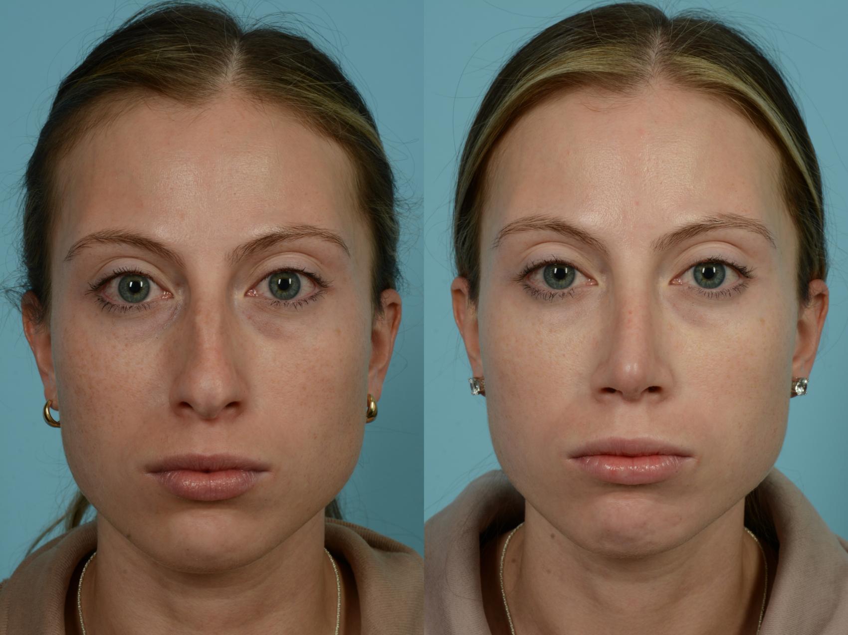 Before & After Rhinoplasty by Dr. Sinno Case 864 Front View in Chicago, IL
