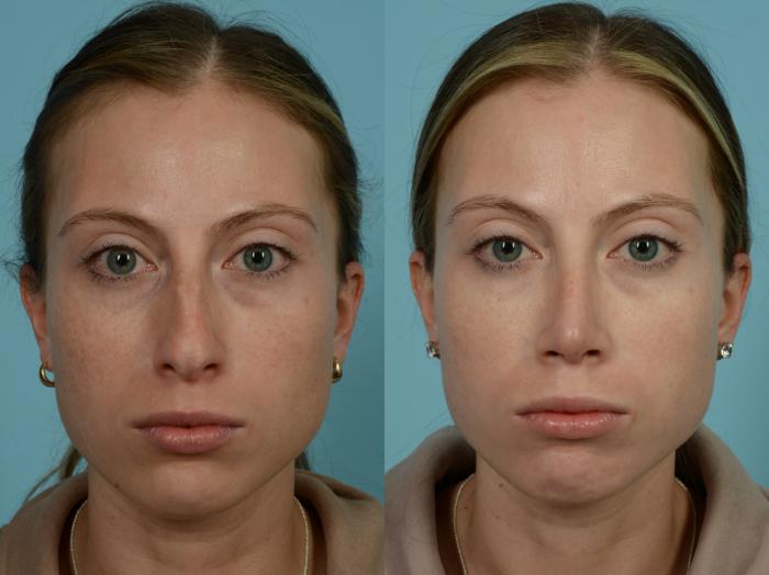 Before & After Rhinoplasty by Dr. Sinno Case 864 Front View in Chicago, IL