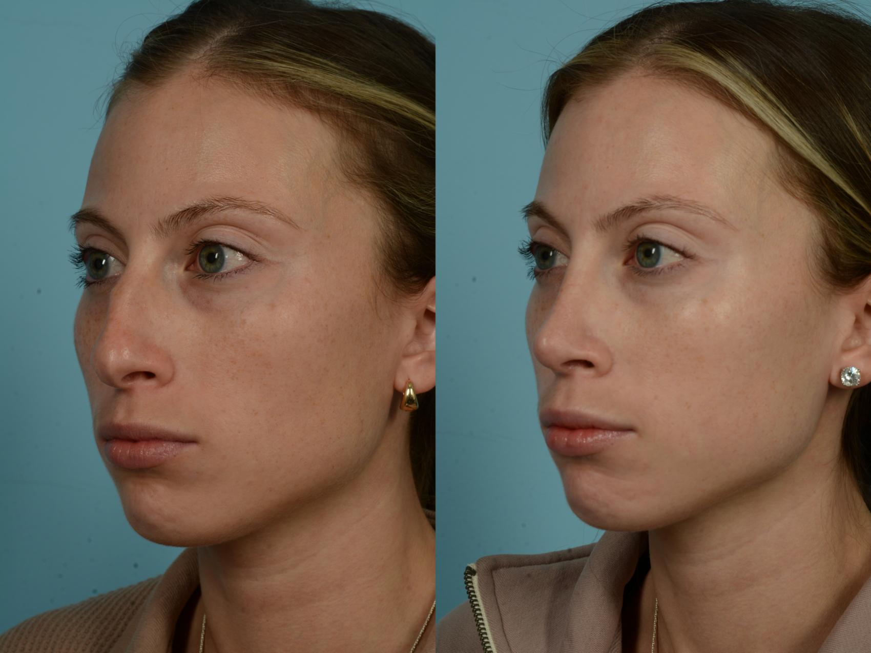 Rhinoplasty By Dr Sinno Before And After Pictures Case 864 Chicago Il Tlkm Plastic Surgery 