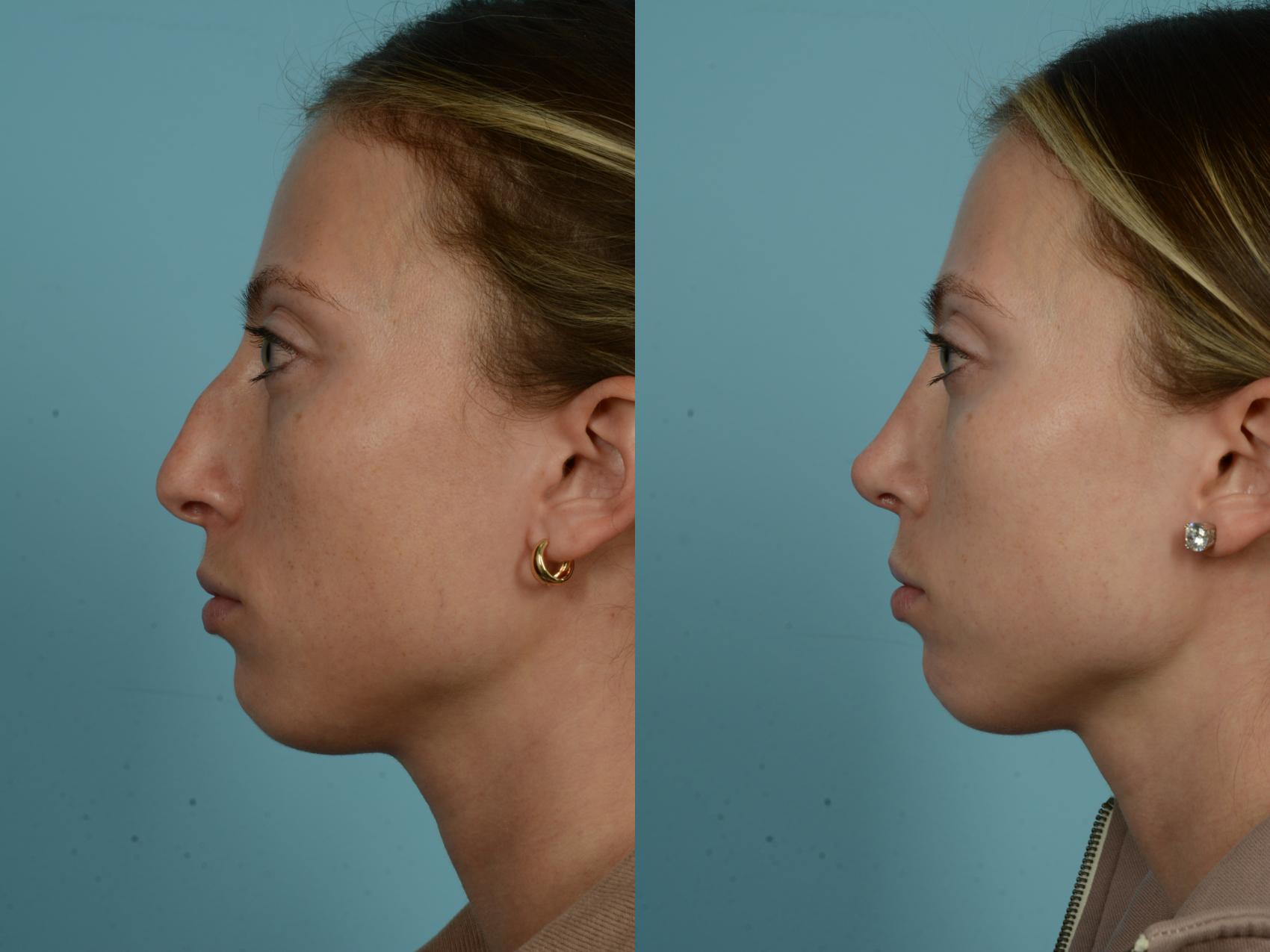 Before & After Rhinoplasty by Dr. Sinno Case 864 Left Side View in Chicago, IL