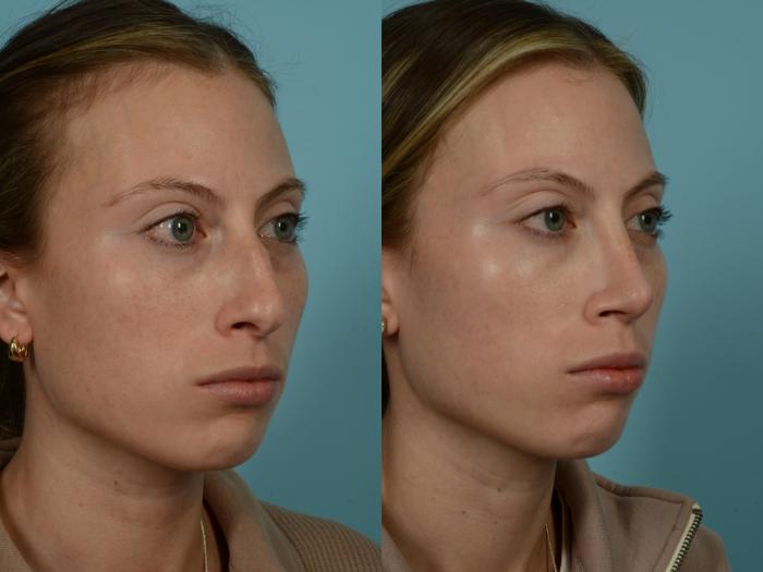 Before & After Rhinoplasty by Dr. Sinno Case 864 Right Oblique View in Chicago, IL