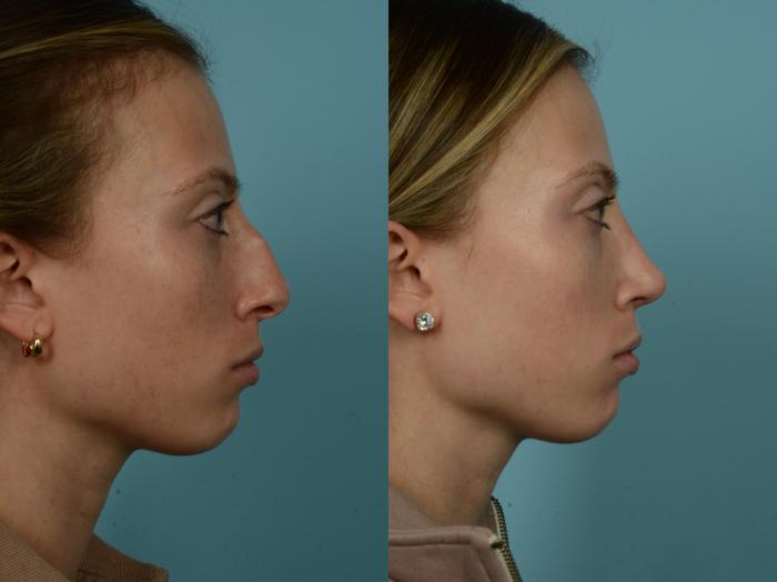 Before & After Rhinoplasty by Dr. Sinno Case 864 Right Side View in Chicago, IL
