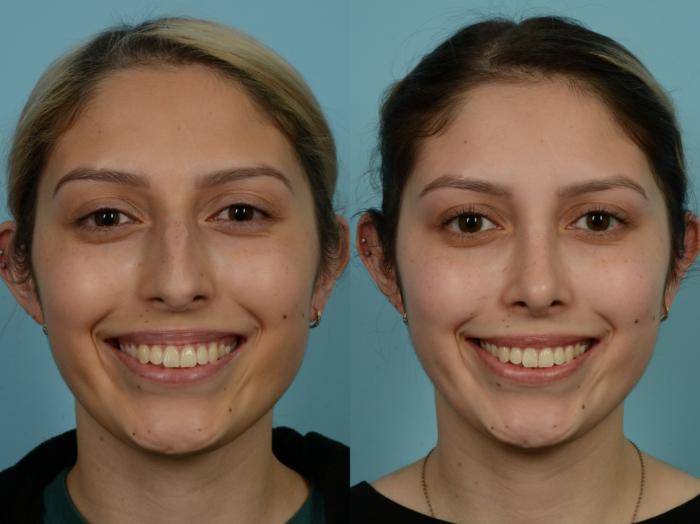 Before & After Rhinoplasty by Dr. Sinno Case 865 Front View in Chicago, IL