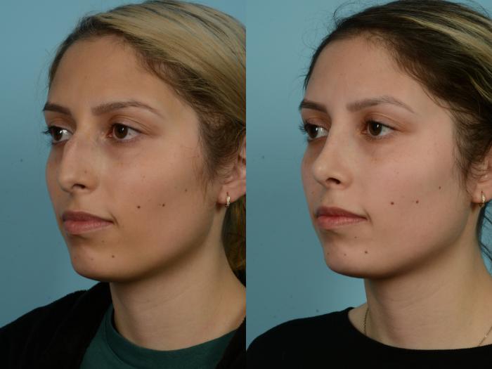 Before & After Rhinoplasty by Dr. Sinno Case 865 Left Oblique View in Chicago, IL