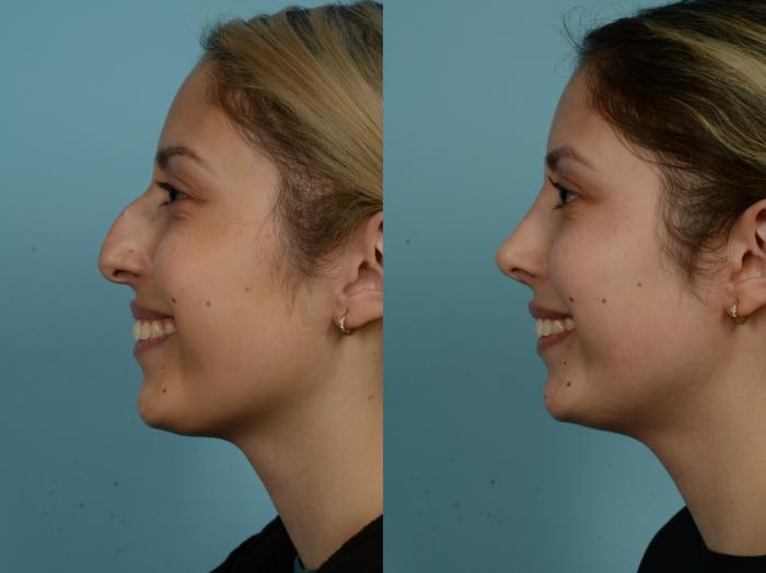 Before & After Rhinoplasty by Dr. Sinno Case 865 Left Side View in Chicago, IL