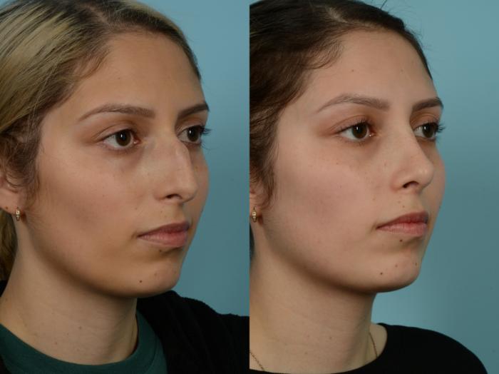 Before & After Rhinoplasty by Dr. Sinno Case 865 Right Oblique View in Chicago, IL