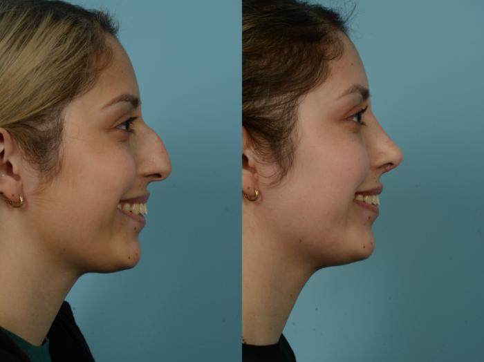 Before & After Rhinoplasty by Dr. Sinno Case 865 Right Side View in Chicago, IL