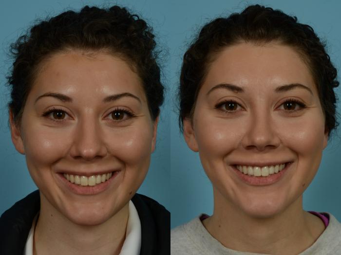 Before & After Rhinoplasty by Dr. Sinno Case 866 Front View in Chicago, IL