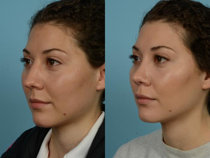 Before & After Rhinoplasty by Dr. Sinno Case 866 Left Oblique View in Chicago, IL