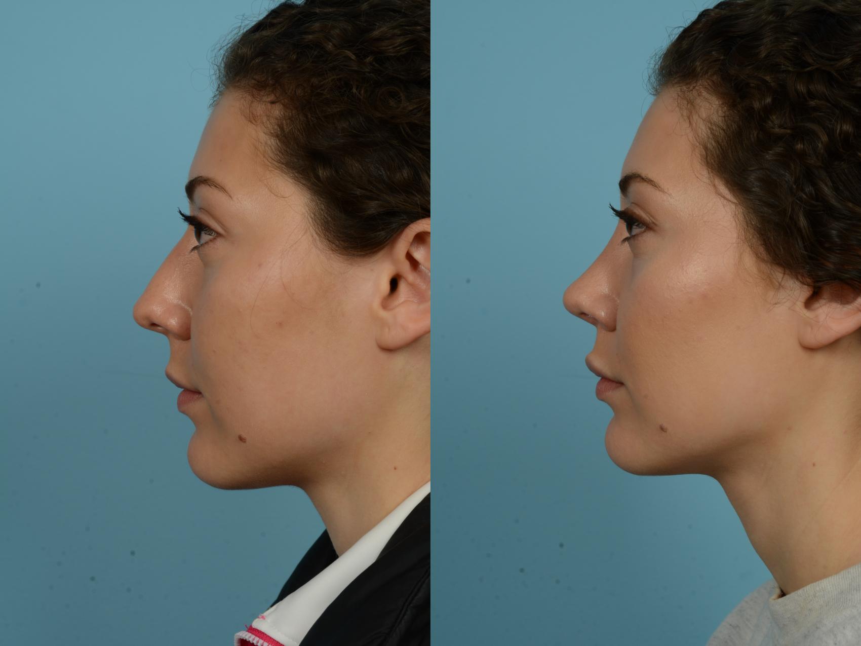 Before & After Rhinoplasty by Dr. Sinno Case 866 Left Side View in Chicago, IL